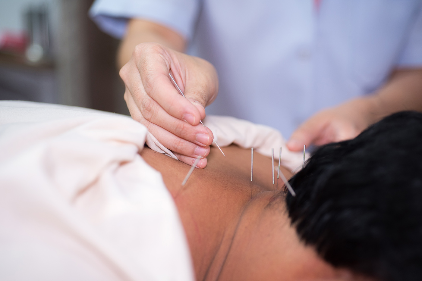 DRY NEEDLING THERAPY